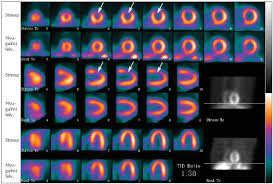 10 éve kontingensünk van terheléses szívizom scintigraphiás