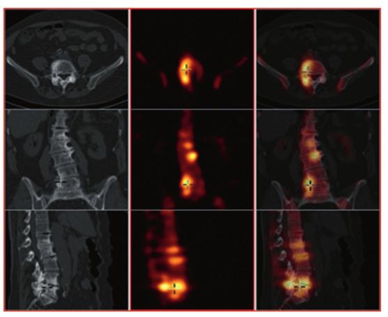 A gyűrű alakú vetületeken a piros szín a jó, a sárga és a zöld szín a csökkent perfúziójú kamrarészeket jelöli SPECT-CT az ábra bal oldalán.