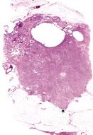 Ultrahang: 26 mm-es körülírt solid echoszegény, inhomogén szerkezetû, kissé irreguláris szélû elváltozás.