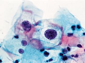 L. G. SIL * HPV * enyhe dysplasia.