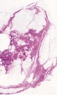 ytológia D typusos hámcsoport, nagy méretû sejtekkel, disszociáció nem