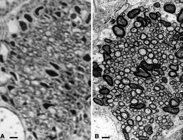 head injury. A small periaxonal fluidfilled space is marked with an asterisk. Microtubuli in A and B are indicated by arrowheads.