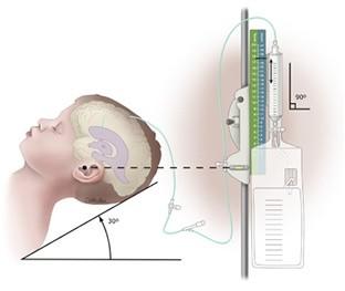 ICP monitorozás gold standard Intraventricularis (kamradrain),