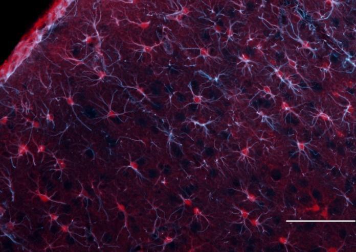 16. ábra: s100-gfap kettős immunjelölés a dmcao modellben az iszkémiás sértéssel azonos oldalon A GFAP (világos kék) és az s100 (piros) immunjelölés az iszkémiás sértésen