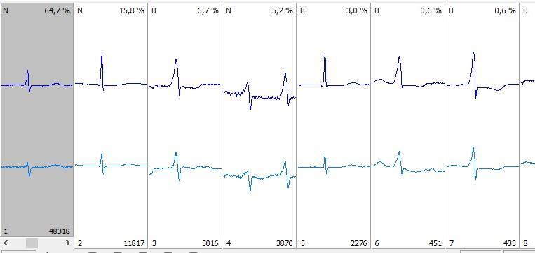 Holter EKG EKG monitorozás - PDF Free Download