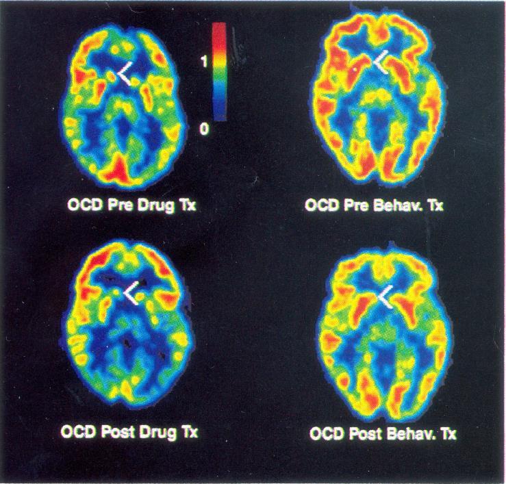 Kényszerbetegség PET vizsgálata: gyógyszeres vs pszichoterápiás kezelés Caudate Glucose Metabolic Rate Changes With Both Drug and