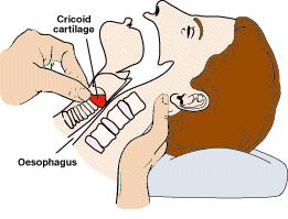 nyomása, illetve a nyak alulról felfelé nyomásával az oesophagust összenyomva elkerülhetjük a regurgitációt. A gyors indukció érdekében alkalmazzuk a gyors hatású iv.