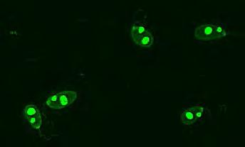 Pozitív dsdns antitest képe HEp-2 sejteken 3.