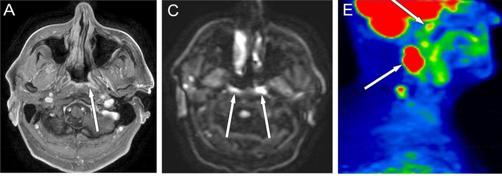 11. táblázat Képalkotókkal vizsgált, hisztológiával igazolt, első klinikai vizsgálattal ismeretlen primer tumorok helyei, nyaki nyirokcsomó metasztázis mellett Tumor helyek MPMRI PET-CT Hisztológia