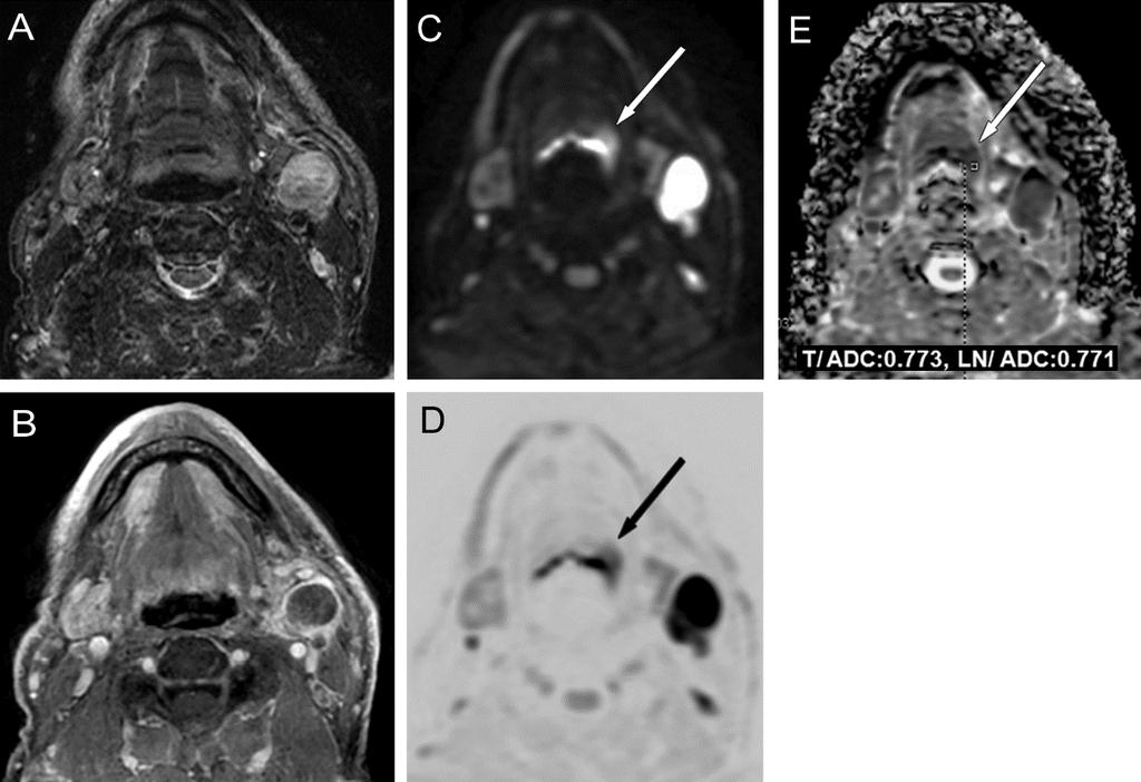 66. ábra DW-MRI-vel kimutatott apró primér tumor A konvencionális mérések (A: STIR, B: CE-T1-FS) nem találták meg a primer tumort.