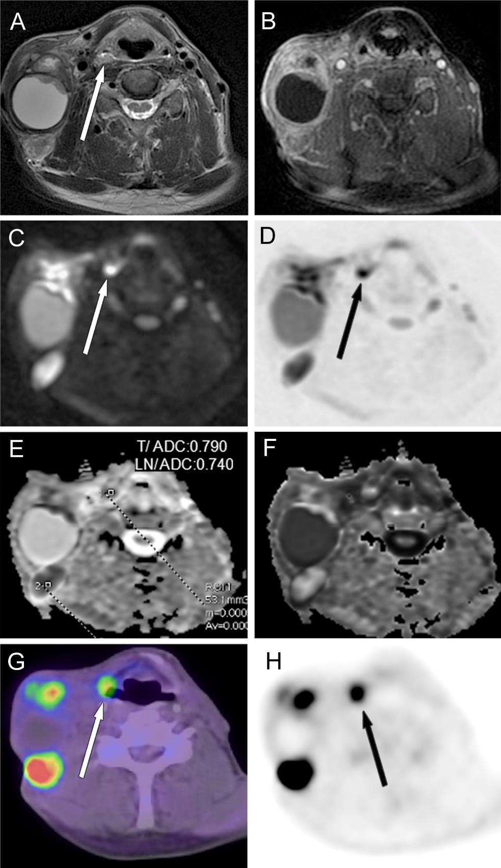 67. ábra Jobb oldali nyirokcsomó metasztázis, primér tumor MP-MRI-vel és PET/CT-vel kimutatott jobb oldali recessus piriformis tumor A: axiális síkú STIR, B: axiális síkú CE-T1--FS rétegek, a jobb