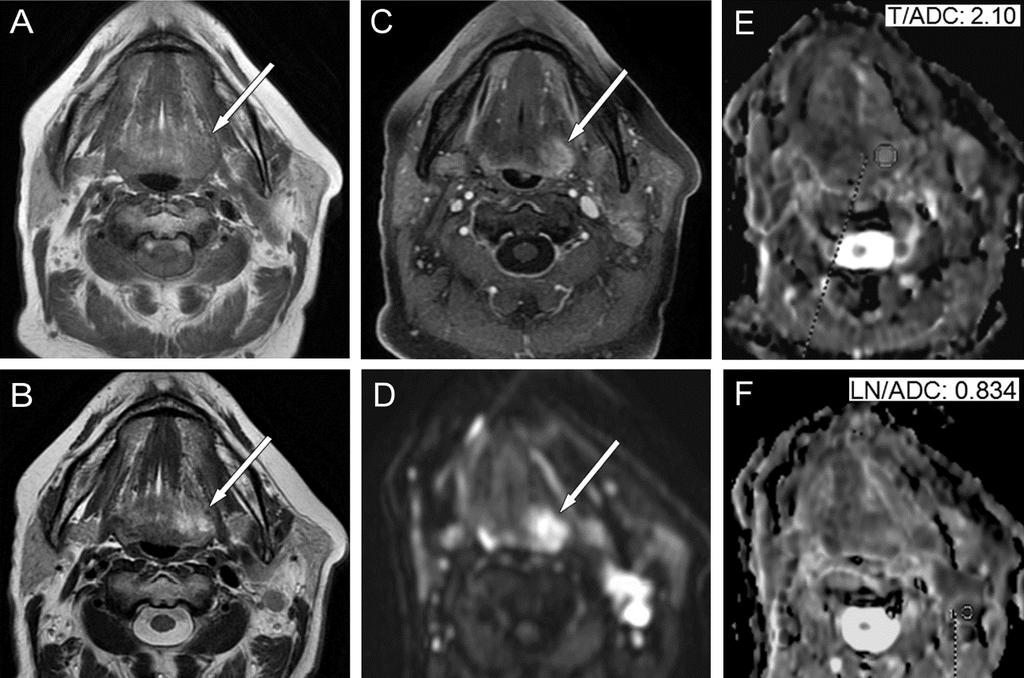 68. ábra A nyelvgyök bal felében a hagyományos sequentiákkal tumor gyanús terület a DW-MRI és az ADC érték alapján gyulladásra utalt A konvencionális MR sequenciák (A: T1-W, B: T2-W, C: