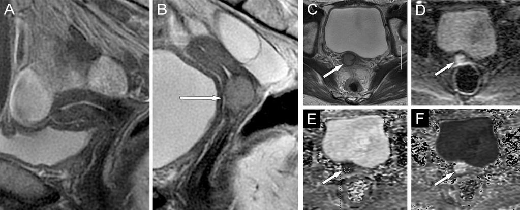 Axiális képek, A1,2: T2-súlyozott, B1,2: diffúzió-súlyozott mérés (b-érték: 1000 s/mm 2 ), C1,2: ADC, D1,2: intravénás kontrasztanyag alkalmazása mellett T1-súlyozott zsírelnyomással készült mérés