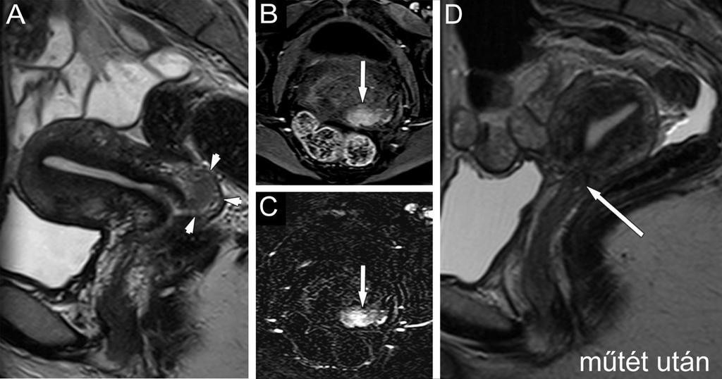75. ábra Korai cervix carcinoma Kisméretű tumor, mely a környezetére nem terjed, a belső méhszájat nem éri el, így a fertilitást megtartó műtét (trachelectomia) elvégezhető volt.