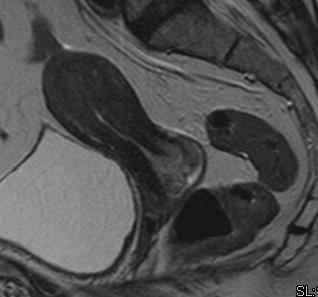 halmozó tumor az MR képen jól elkülönül, B: a betegnél CT