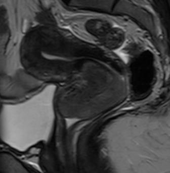 ábra Cervix carcinoma, T2-súlyozott szagittális síkú MR képek