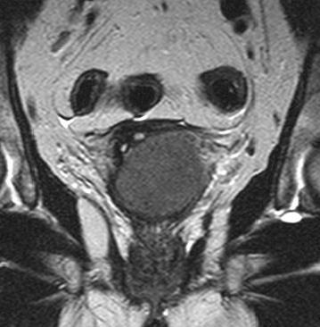 A tumor a hüvelybe domborodik, A legnagyobb kiterjedése a 4