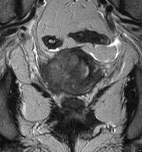 ábra Cervix carcinoma T2b stádium T2 súlyozott coronalis síkú