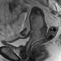 A B 81. ábra Cervix carcinoma a hüvely felső 2/3-ára ráterjed (nyíl), std: T3b Szagittális síkú MR képek, A: T2 súlyozott B: kontrasztanyagos T1-súlyozott zsírszuppresszióval.