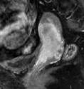 Az MRI pontossága CC stádium meghatározásában 90 % fölött van (Hricak 2005, Medical 2011, Epstein 2013), parametriális invázió kimutatására pontossága 88-97% specificitása 93% (Sala 2007), negatív