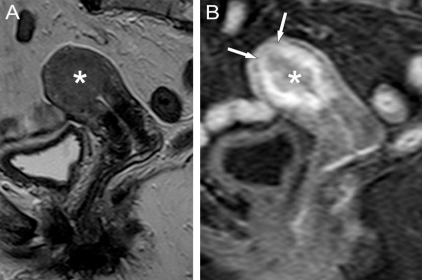 2010) Ha a tumor csak a nyálkahártyát érinti, vagy a myometrium falát kevesebb, mint 50 %- ban szűri be (I/A stádium), a nyirokcsomó metasztázis valószínűsége csekély és ilyenkor elég lehet az