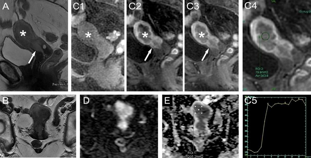MRI hasznos az uteruson kívüli tumor terjedés értékelésében, a peritonealis metasztatikus gócok, nyirokcsomók megítélésében egyaránt.