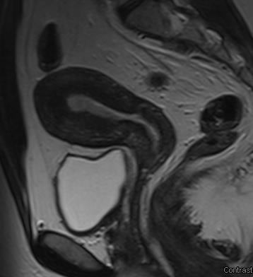 Az uterus normál zonális anatómiája a T2 súlyozott mérésen jól elkülöníthető, a normál endometrium magas-, míg a tumor általában közepes jelintenzitású.