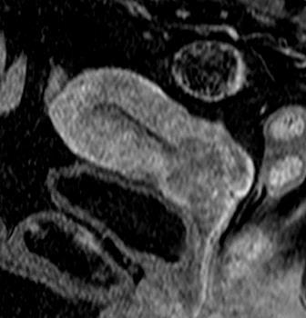 szagittális síkú képen a tumor (csillag) a myometrium