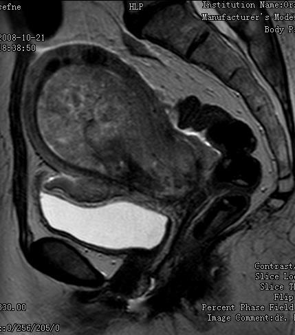 ábra A tumor a cervicalis stromába terjed.