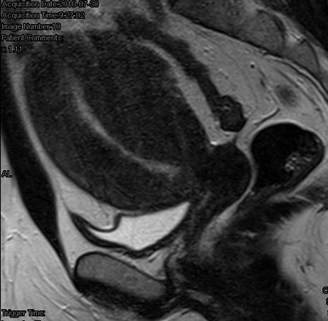 A B Megbeszélés 91. ábra, A: Adenomyosis B: myoma T2-súlyozott szagittális síkú MR képek. A: az endometrium átszövi a myometriumot, a tumor ezen belül nem különíthető el.