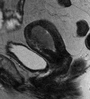 A B 93. ábra Az endometrium carcinoma mélységi inváziója MRI-vel nem volt meghatározható A: T2-súlyozott sagittalis síkú MR mérésen a tumor (csillag) egy része a myometriummal csaknem egyező jelet ad.