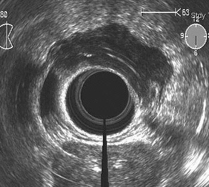 KÉPALKOTÓ MÓDSZEREK A RECTUM CARCINOMA VIZSGÁLATÁBAN (Gődény 2011 Medicina, Jederán-Gődény 2009, 2010, 2012 Magy. Onk.