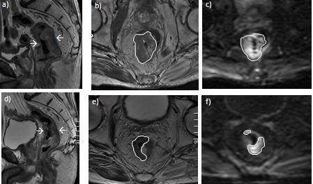 A B C D E F 95. ábra Rectum tumoros beteg 3T MR berendezéssel készült MP-MRI vizsgálata, preoperatív kezelés előtt és után. A kemoradioterápia után a diffúzió gátlás mérséklődött.