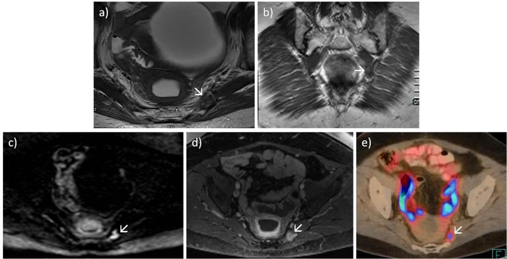 körkörösen infiltrál és a kontúr egyenetlensége, a perirectalis zsír köteges jellege arra utal, hogy a tumor a rectum falát áttörte C: Diffúzió-súlyozott (DW-MR, b érték:1000 sec/mm 2 ) kép