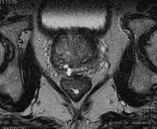 Rectum carcinoma tumor stádiumának meghatározása MRI-vel (Gődény 2011 Medicina, Jederán-Gődény 2009, 2010, 2012 Magy. Onk.