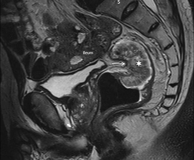 , 2015 PORE) A végbél MRI - megfelelő technika mellett- a rectum carcinoma (RC) legpontosabb állapotfelmérője, mind a lokális tumor stádium (T), mind a tumor és a terápia szempontjából fontos