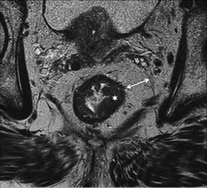 High resolution (HR) MRI-vel történő T stádium meghatározás elsősorban a T2-súlyozott méréseken alapszik, mivel a tumor közepes jelintenzitása jól elkülönül a környező zsír magasabb