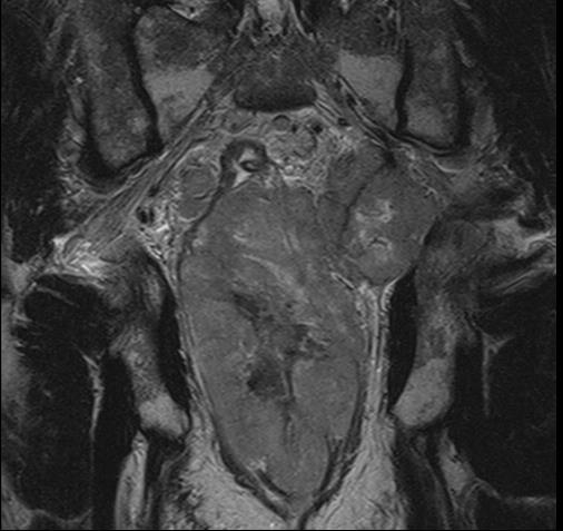 A rectum alsó harmadában jobb oldali túlsúlyú, lumenszűkületet okozó T4 tumor (csillag) képe.