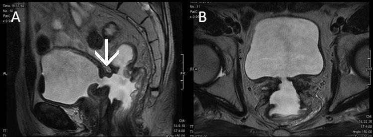 megkezdését követő 6 hónappal tumor progresszió figyelhető meg a dorsalis hólyagfal