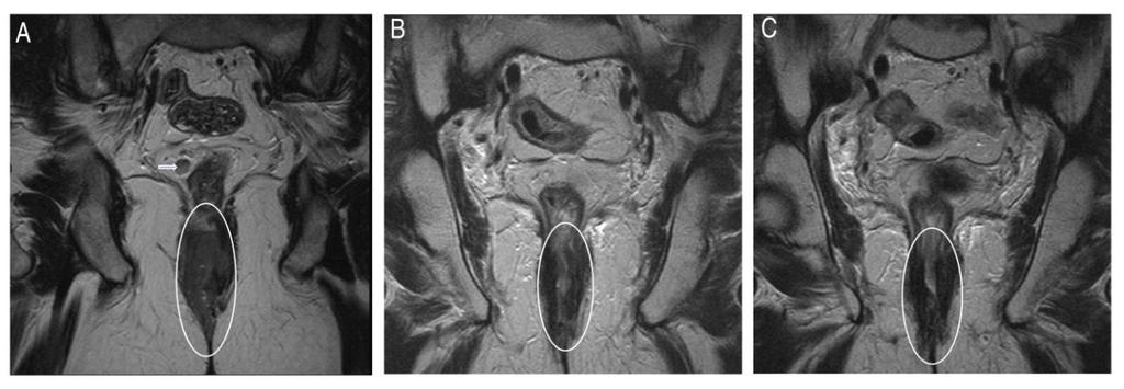 terjed, C kép coronális: a tumor infiltrálja a belső sphinctert (C kép, nyílfej) A primer elváltozásoknál a korai (Tis, T1, T2, 71%)-, recidíváknál az előrehaladott stádiumú daganatok (T3, T4, 53,8%)