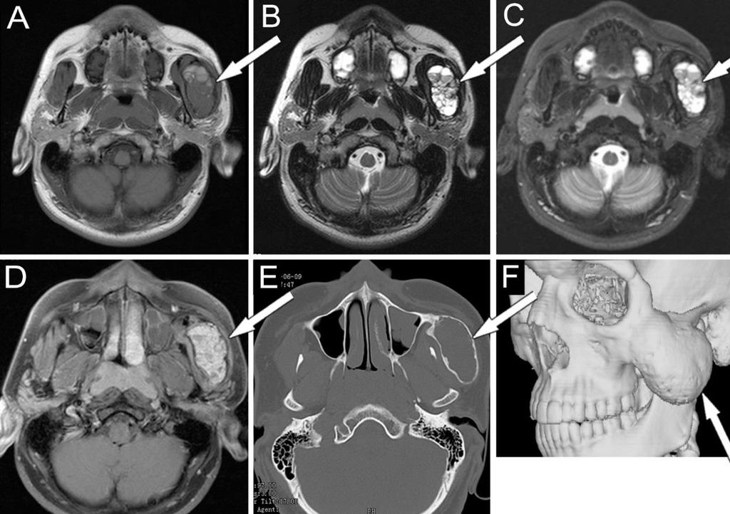 SAJÁT ESET TANULMÁNY Zygomaticus ívben elhelyezkedő ritka csont tumor - aneurysmás csontcysta (ACsC) - CT és MRI összehasonlító tanulmánya Lerant G, Ivanyi E, Toth E, Levai A, Gődény M.