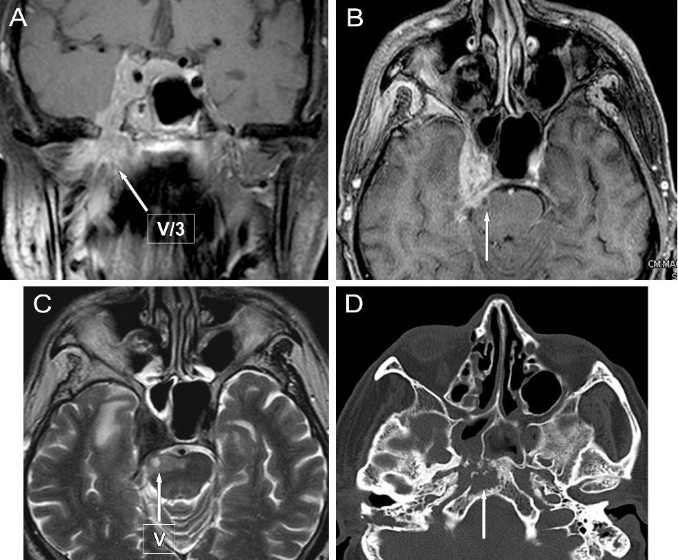 3. ábra Kiterjedt nasopharynx carcinoma (NPhCA) a koponyabázis destrukciójával és perineurális terjedéssel az agytörzsbe (T4 stádium) A,B,C képek MR rétegek, D kép CT réteg A, B: coronalis és axiális