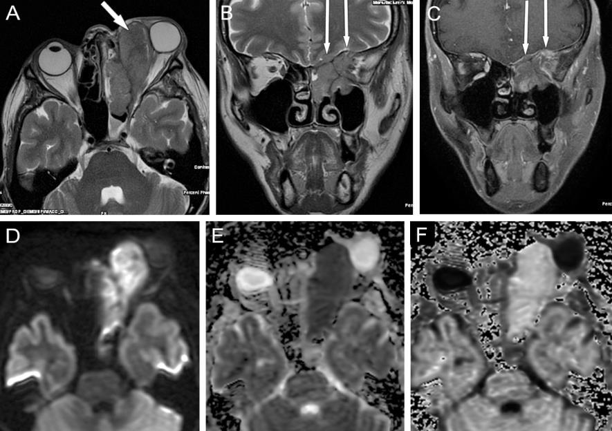 4. ábra Rostasejt carcinoma, bal oldalon beterjed az orbitába (rövid nyíl), a rhinobasison át epidurálisan is terjed (hosszú nyilak) A: T2-súlyozott (T2-w) axiális, B: T2-w coronalis, C: