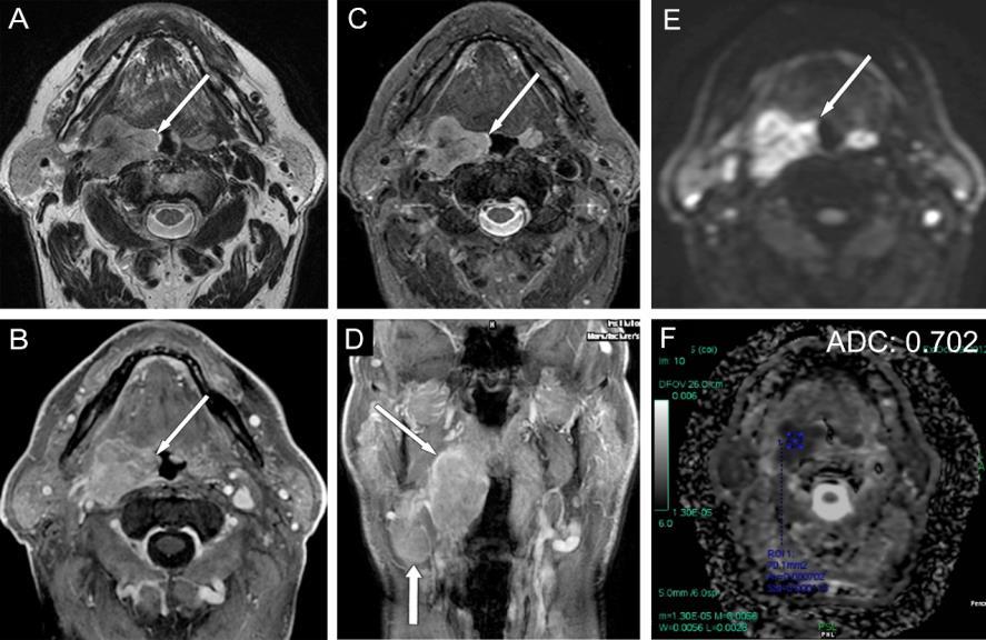 A coronalis síkú magas felbontású rétegek alkalmasak arra, hogy a tumor intracranialis terjedését, durához való viszonyát meghatározhassuk.
