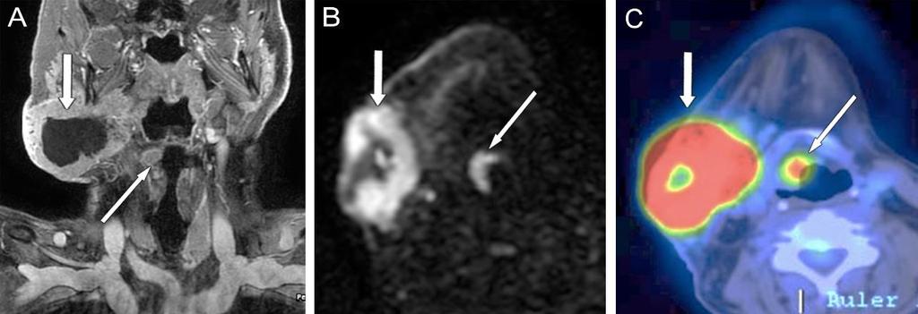 6. ábra Supraglottikus, kisméretű carcinoma jobb oldalon (hosszú nyíl), azonos oldali nagyméretű, colliquálódott nyirokcsomó metasztázissal (rövid nyíl) A: coronalis síkú CE-T1-FS réteg, B: diffúzió
