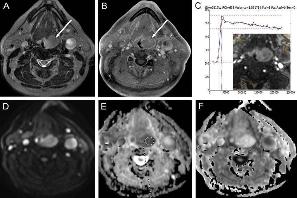 8. ábra Tonsilla linguális carcinoma bal oldalon azonos oldali nyirokcsomó metasztázissal Axiális síkú rétegek, A: STIR, B: CE-T1-FS, C: a kontraszthalmozás dinamikáját feldolgozó idő-halmozás görbe,