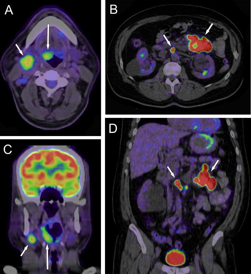9. ábra FDG-PET/CT vizsgálat, kettős tumor képe A és C képek: nyaki régióban jobb oldali nyelvgyök carcinoma (hosszú nyíl) és azonos oldali nyirokcsomó metasztázis (rövid nyíl) fokozott FDG felvétele