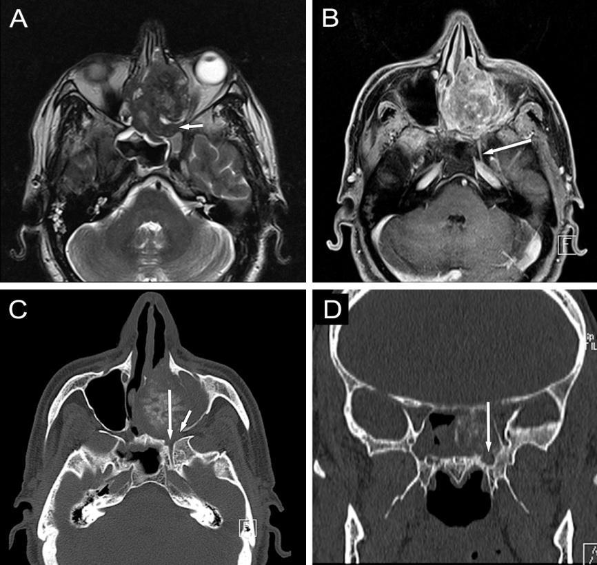 11. ábra Orrüregből, rostasejtekből kiinduló adenoid cysticus carcinoma, T4b stádium A, B: 1.5T MR képek, A: axiális T2-súlyozott, B: axiális iv.
