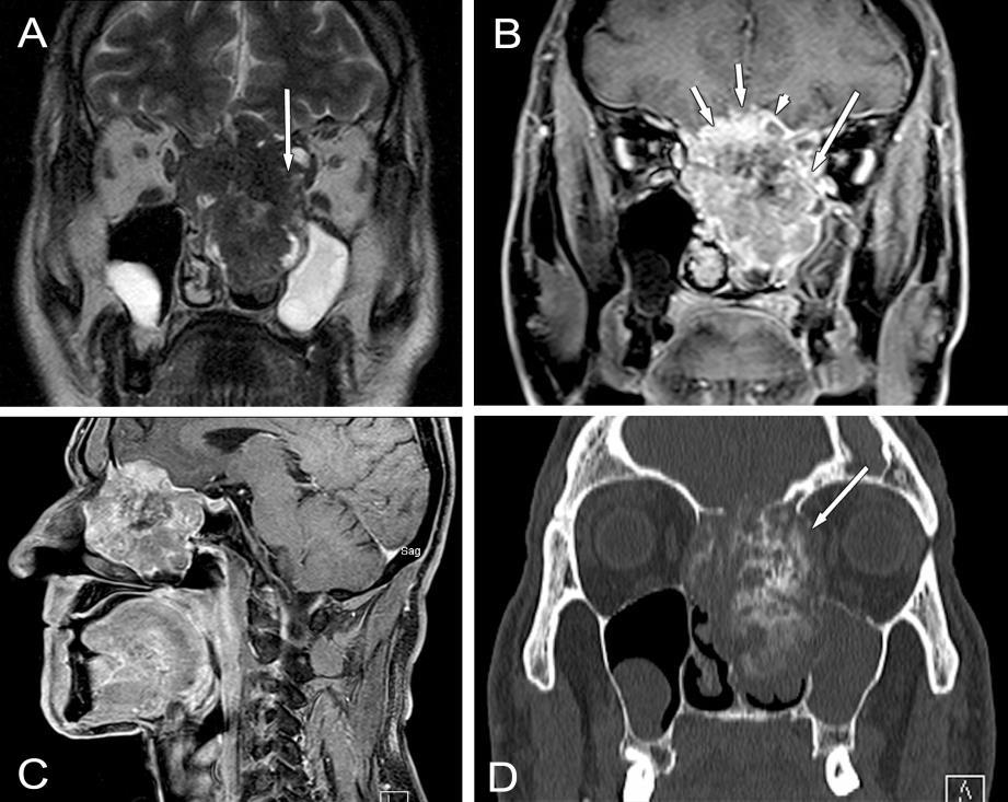 jelintenzitású gyulladástól. A tumor hozzáfekszik a mediális orbita falhoz (rövid nyíl), eléri a rhinobasist (hosszú nyíl), de sem az orbitába, sem intracraniálisan nem terjed.