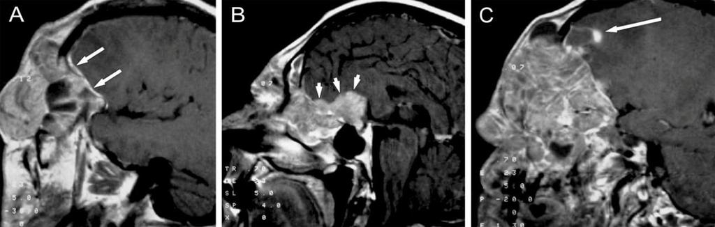 kép, hosszú nyíl) át a sinus cavernosusba (SC, D kép, rövid nyíl). 15. ábra Orr- melléküreg carcinoma intracraniális terjedése, T4b stádium A, B, C: 1.